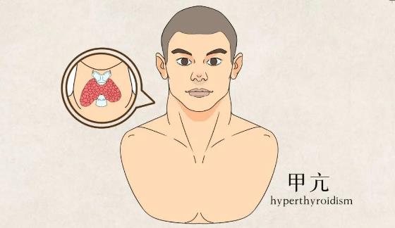 甲状腺功能亢进症